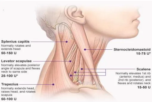Toxina Botulínica para Distonia e Espasticidade