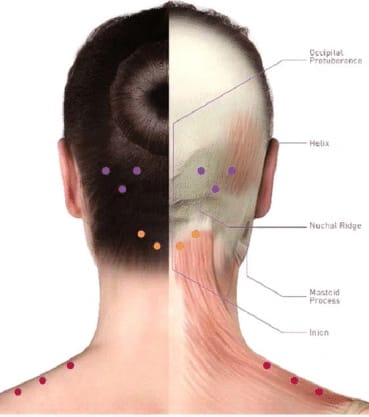 Toxina Botulínica para Enxaqueca Crônica